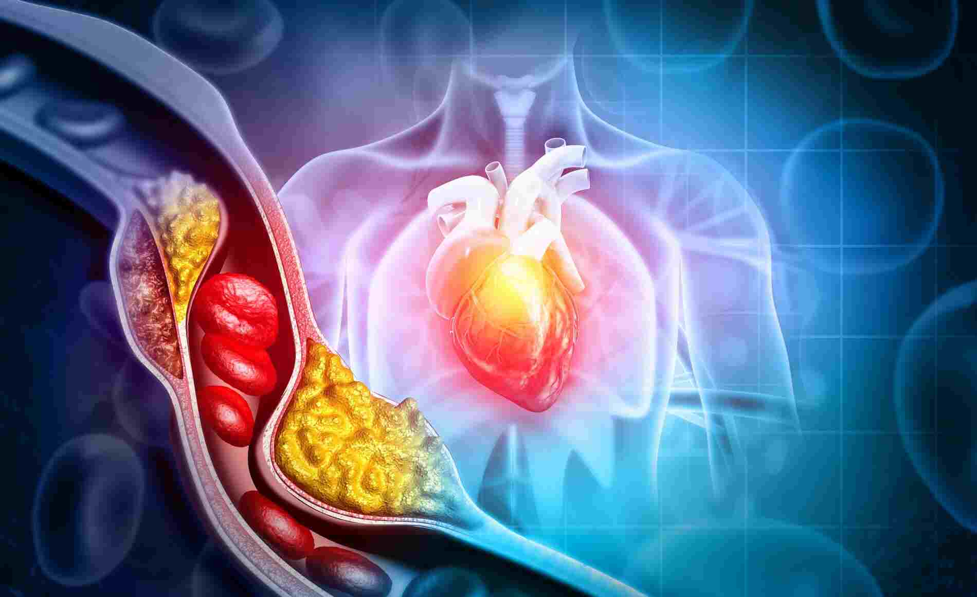 Do you know High Cholesterol Diseases?